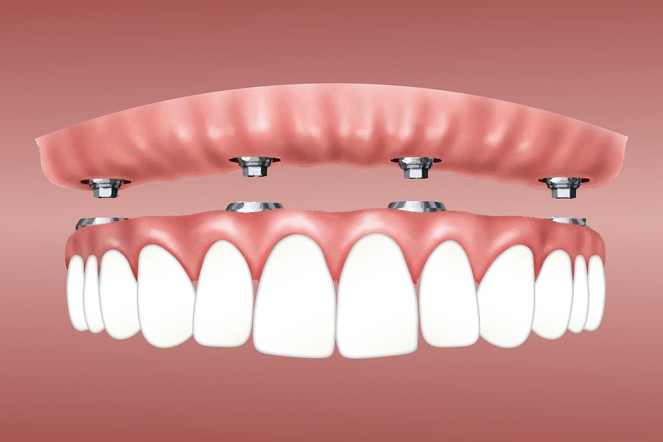 Implanty stomatologiczne – co warto o nich wiedzieć?
